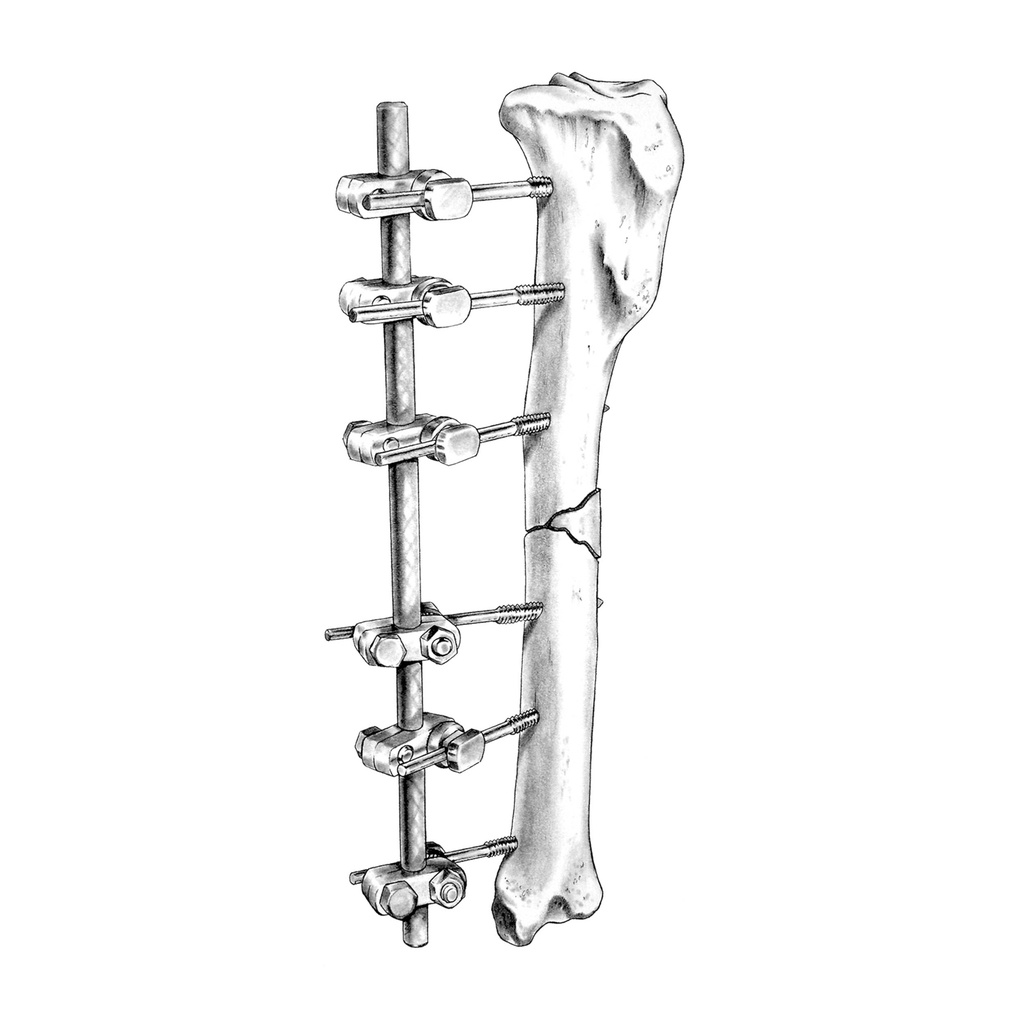 SK External Skeletal Fixation System Medium, Starter Kit