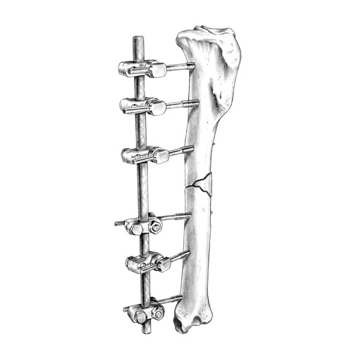 [180300] SK External Skeletal Fixation System Medium, Starter Kit